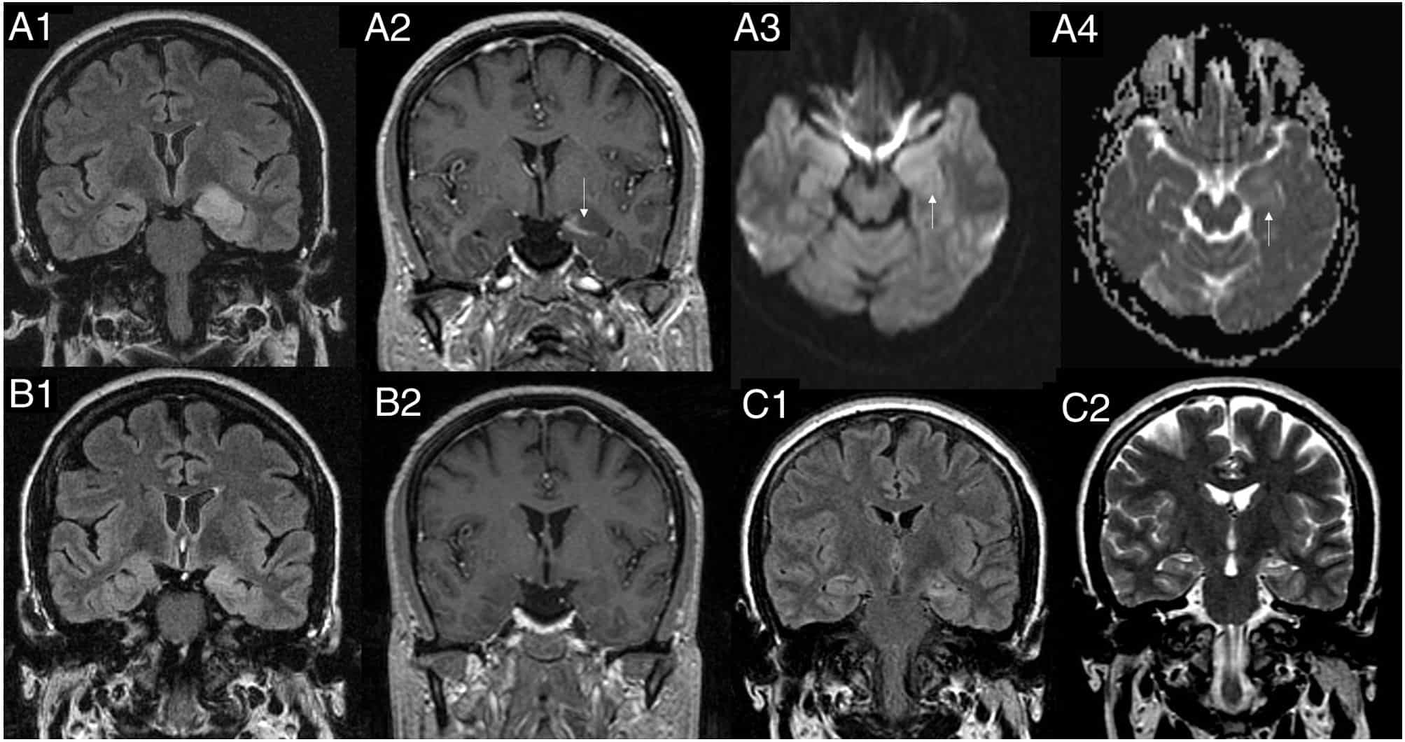 Neuroimagen en Epilepsia: RM, PET, SPECT y Nuevas Herramientas